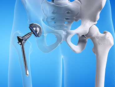 chanakya-hospital-hip-replacement-in-cuttack Chanakya hospital Cuttack